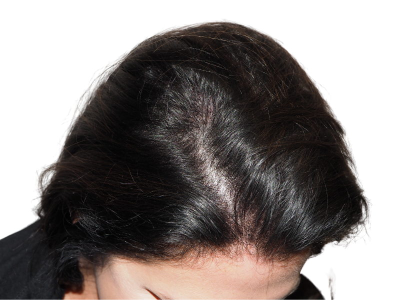 Thinning hair at crown. Potential hair loss. Consider hair restoration options like hair transplants for fuller hair.