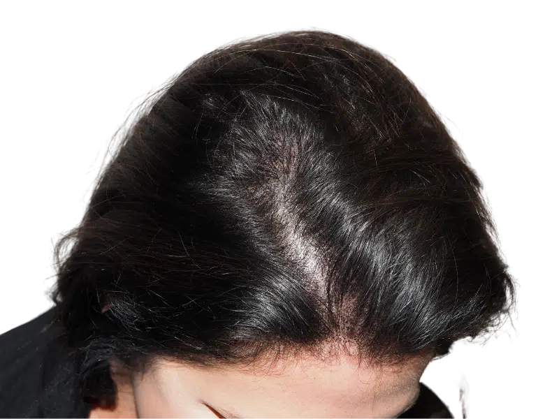 Thinning hair at crown. Potential hair loss. Consider hair restoration options like hair transplants for fuller hair.