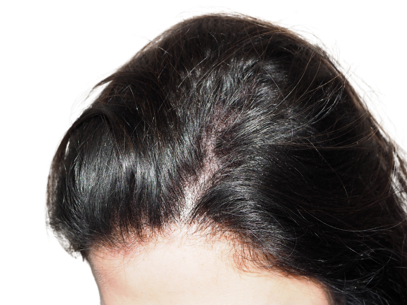Hair transplant before & after: Restored hairline with improved density. Dark hair, Caucasian male. Hair restoration results.