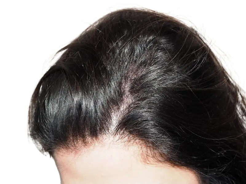 Hair transplant before & after: Restored hairline with improved density. Dark hair, Caucasian male. Hair restoration results.