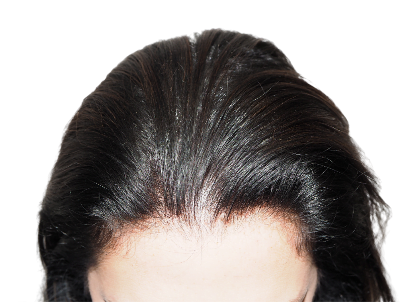 Hair transplant result: Natural hairline restoration. Before & after visible. Dark hair, successful procedure.