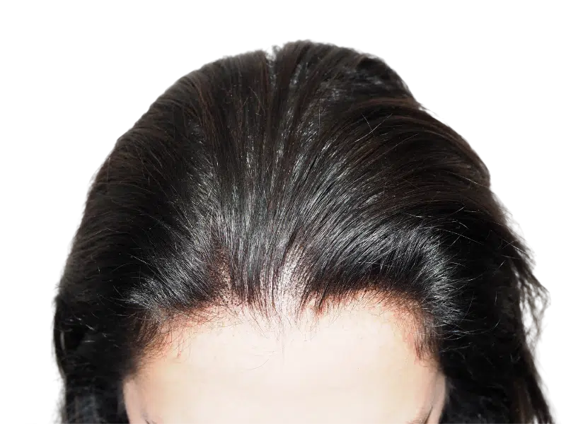 Hair transplant result: Natural hairline restoration. Before & after visible. Dark hair, successful procedure.