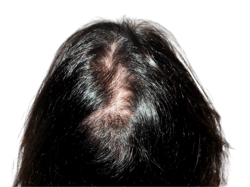 Thinning hair at crown. Potential hair loss candidate. Consider hair restoration or transplant options for fuller hair.