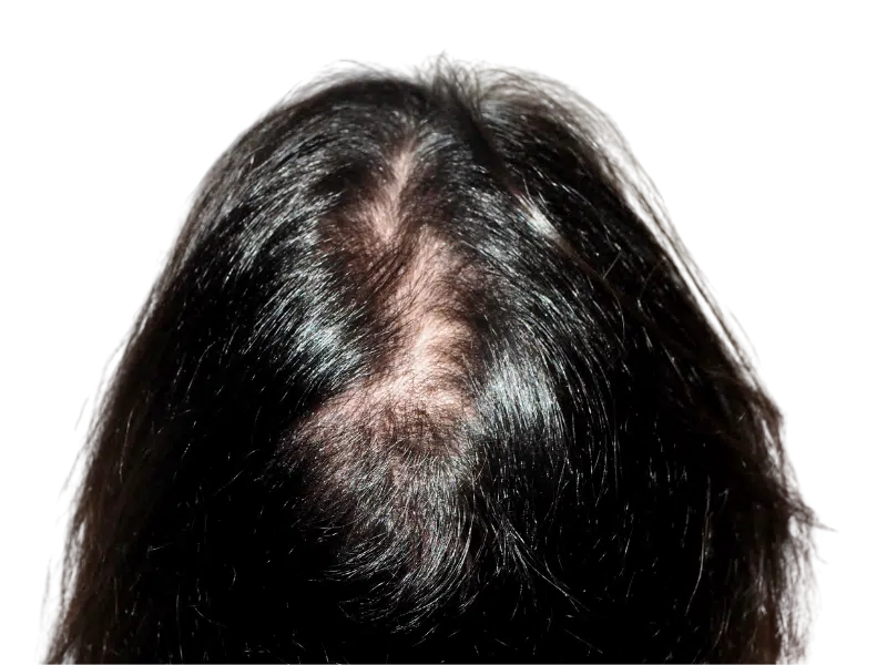 Thinning hair at crown. Potential hair loss candidate. Consider hair restoration or transplant options for fuller hair.