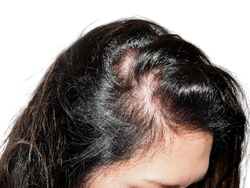 Hair thinning at hairline. Example of hair loss treatable with hair restoration or hair transplant procedures.