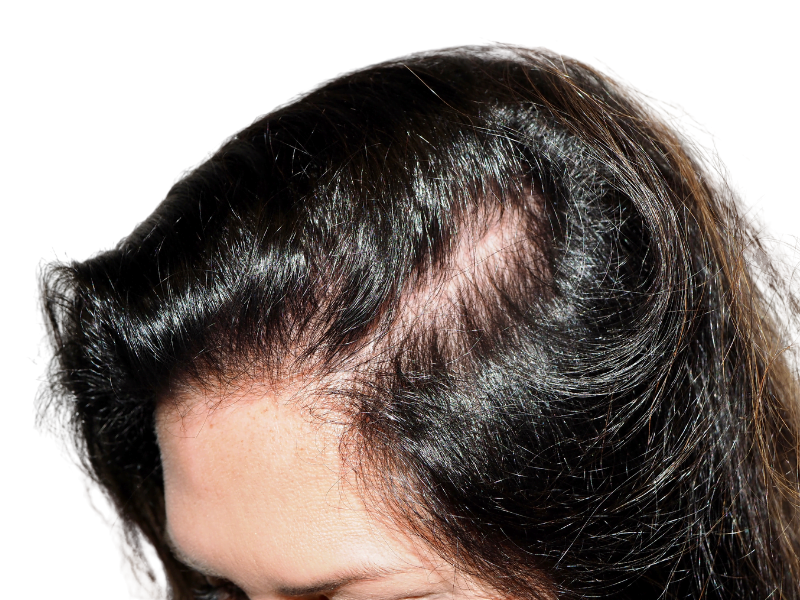 Thinning dark brown hair at hairline. Hair loss example for hair restoration or transplant consideration.