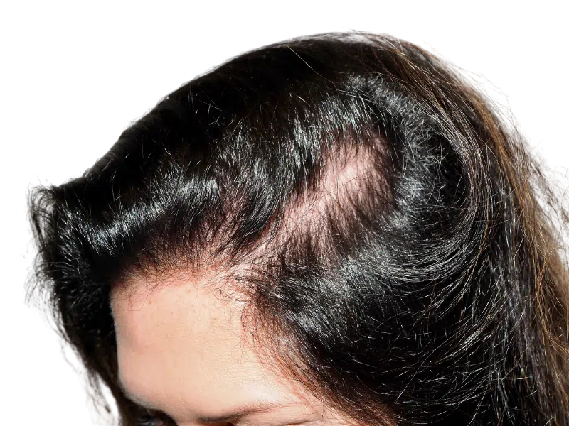 Thinning dark brown hair at hairline. Hair loss example for hair restoration or transplant consideration.