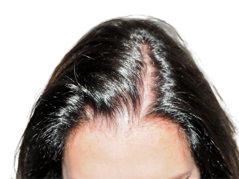 Thinning hairline. Potential hair restoration candidate. Before hair transplant. Dark hair, receding hairline.