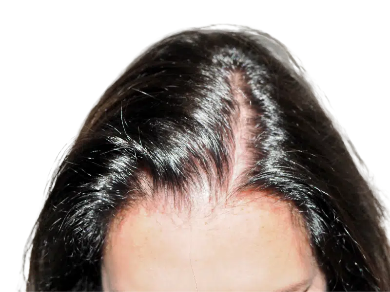 Thinning hairline. Potential hair restoration candidate. Before hair transplant. Dark hair, receding hairline.