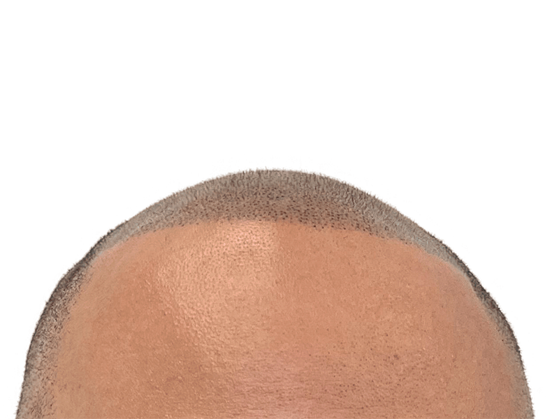 Hair transplant result: Defined hairline on tan skin. Short, dark hairs indicate recent hair restoration procedure. Before/after results may vary.