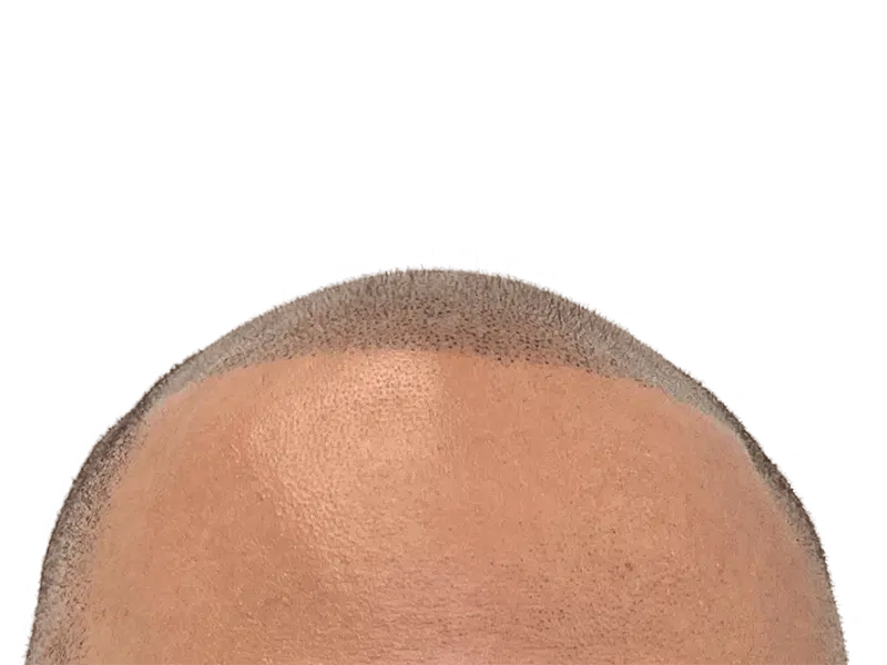Hair transplant result: Defined hairline on tan skin. Short, dark hairs indicate recent hair restoration procedure. Before/after results may vary.