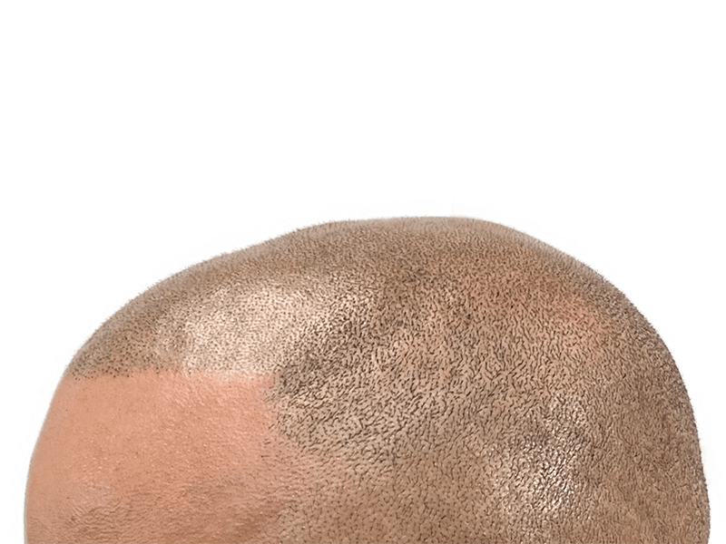 Hair transplant result: Improved density on scalp. Before/after hair restoration procedure. Dark, short hair.