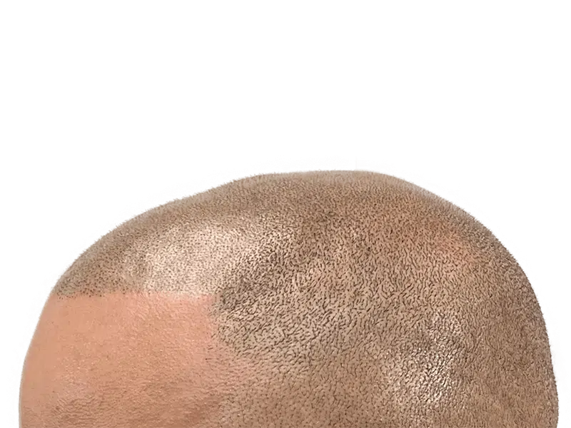 Hair transplant result: Improved density on scalp. Before/after hair restoration procedure. Dark, short hair.