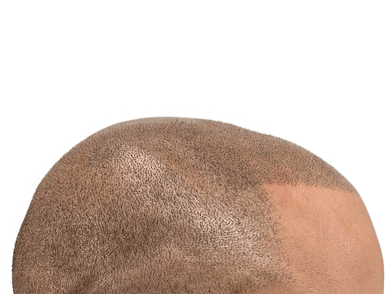 Hair transplant before & after: Increased hair density on African American/Hispanic scalp. Hair restoration results.