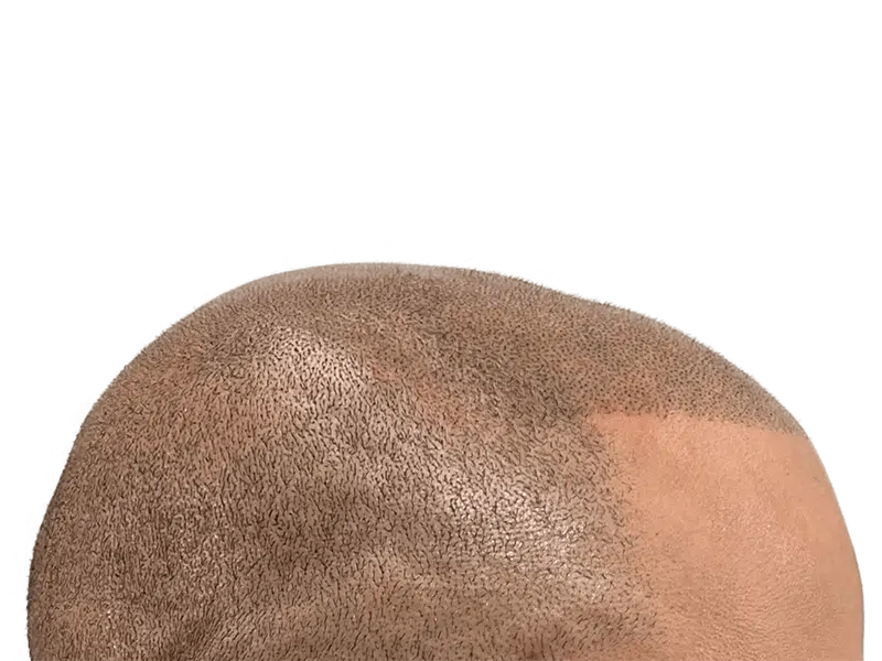 Hair transplant before & after: Increased hair density on African American/Hispanic scalp. Hair restoration results.