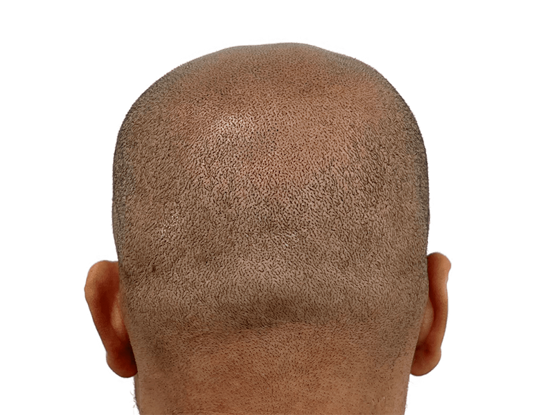 Shaved head showing potential hair transplant area. Dark hair, light brown skin. Considering hair restoration options?