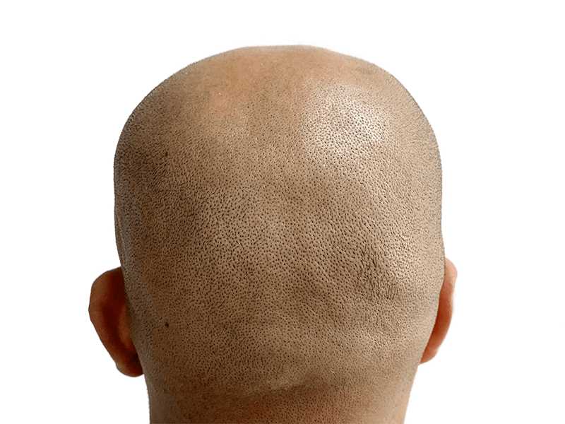 Hair transplant result: Shaved head showing even hair growth post-procedure. No visible scarring. Hair restoration success.
