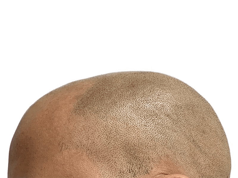 Hair transplant result: Restored hairline with uniform density. Before/after hair restoration success.