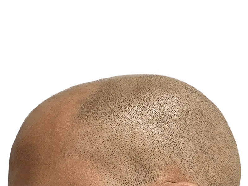 Hair transplant result: Restored hairline with uniform density. Before/after hair restoration success.