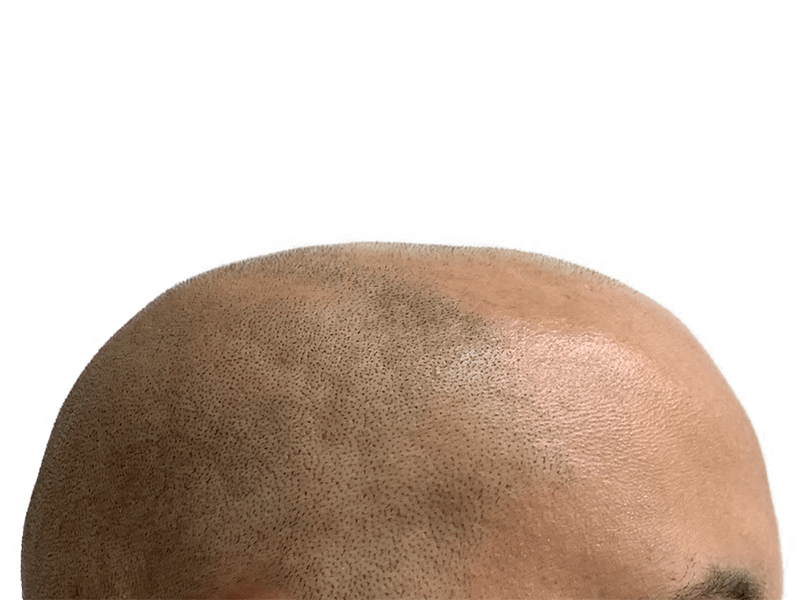 Hair transplant result. Close-up of restored hairline. Follicles visible. Hair restoration procedure success.
