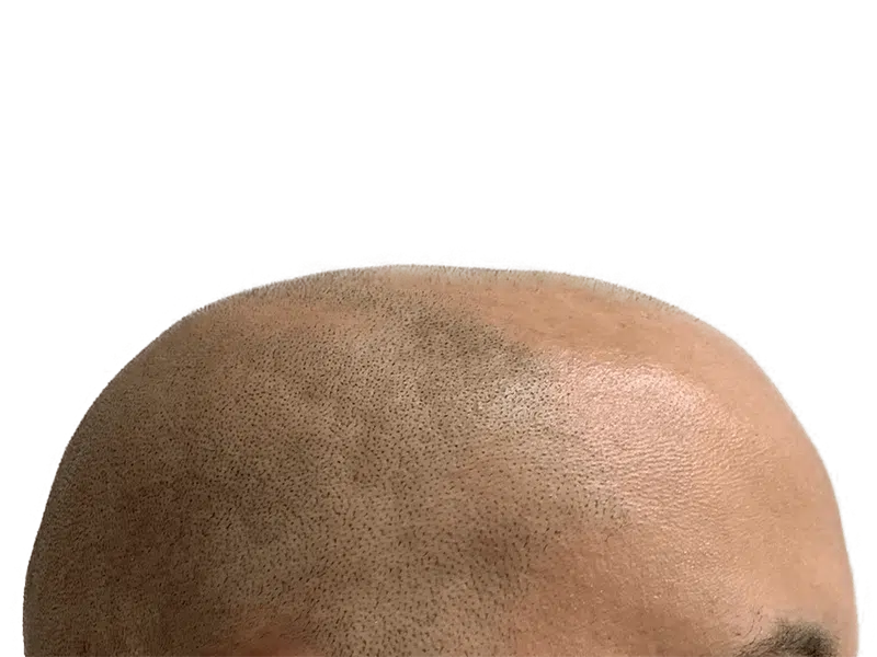 Hair transplant result. Close-up of restored hairline. Follicles visible. Hair restoration procedure success.