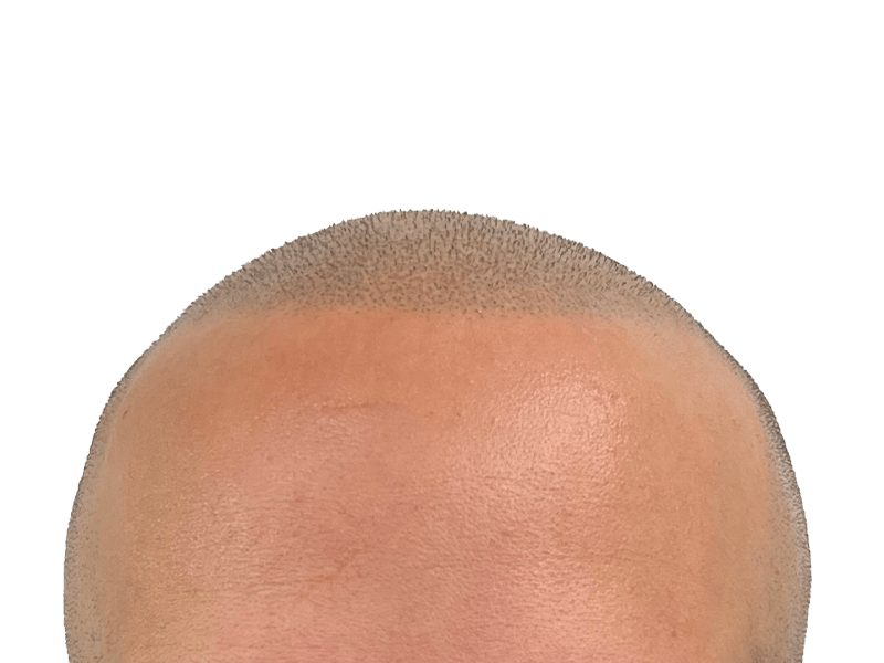 Hair restoration result: Dense, evenly distributed hair after transplant. Healthy scalp, closely cropped hair. Before/after potential.