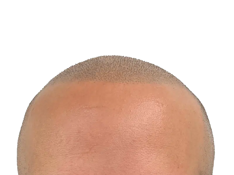 Hair restoration result: Dense, evenly distributed hair after transplant. Healthy scalp, closely cropped hair. Before/after potential.