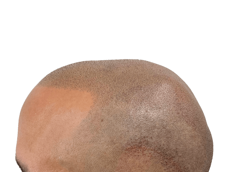 Hair transplant result: denser frontal hairline. Before/after hair restoration procedure. Light brown skin.