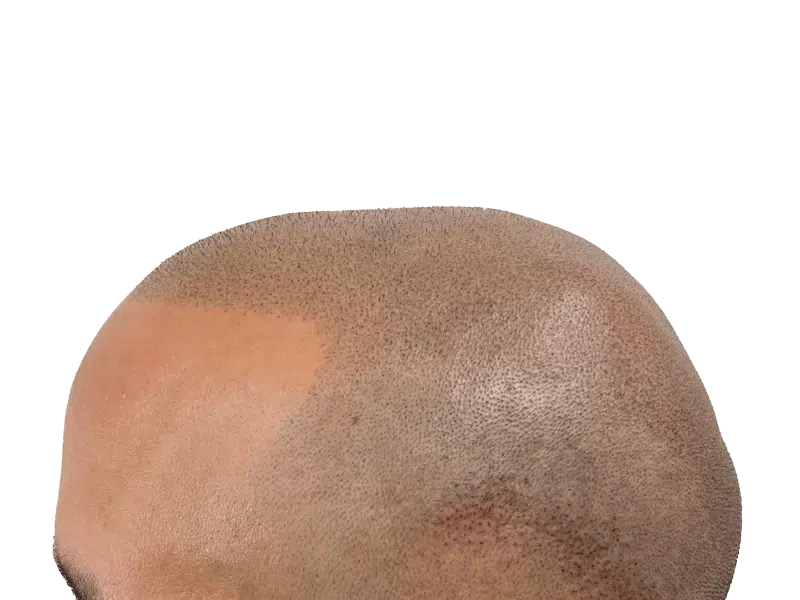 Hair transplant result: denser frontal hairline. Before/after hair restoration procedure. Light brown skin.