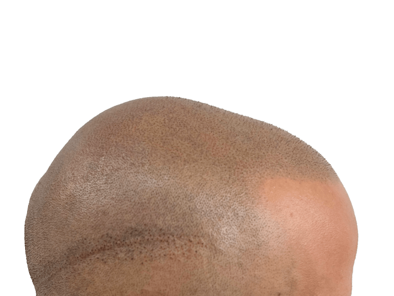 Scalp micropigmentation result. Bald head with simulated hair follicles. Hair restoration procedure. Before/after comparison needed.