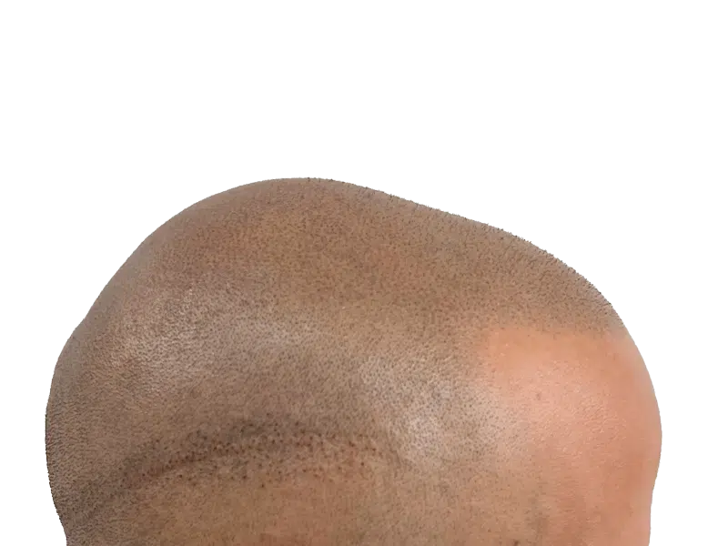 Scalp micropigmentation result. Bald head with simulated hair follicles. Hair restoration procedure. Before/after comparison needed.