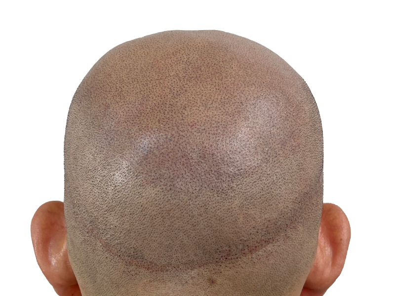 Hair transplant scar & follicle placement. Post-op scalp close-up. Hair restoration results. Before/after potential.