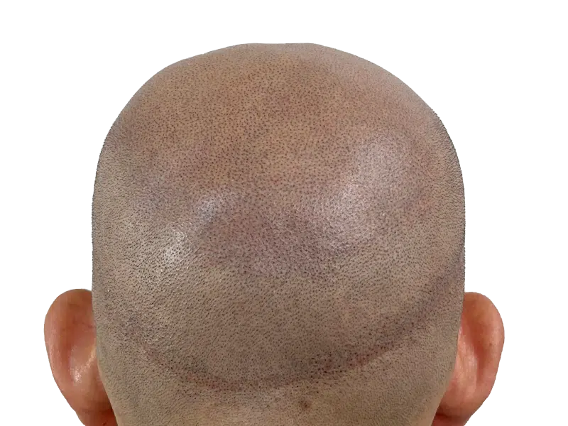Hair transplant scar & follicle placement. Post-op scalp close-up. Hair restoration results. Before/after potential.