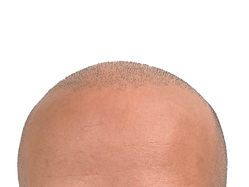 Receding hairline before hair restoration. Possible hair transplant. New hair growth visible. Light skin tone.