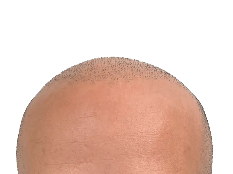 Receding hairline before hair restoration. Possible hair transplant. New hair growth visible. Light skin tone.
