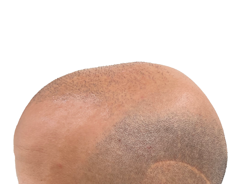 Hair transplant result: Visible scalp with denser hair growth in front, showcasing hair restoration success.