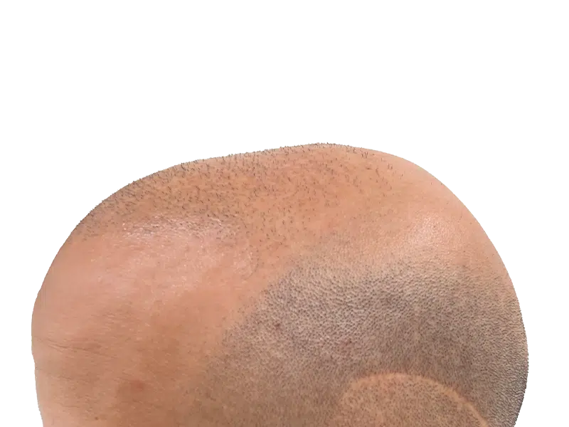 Hair transplant result: Visible scalp with denser hair growth in front, showcasing hair restoration success.