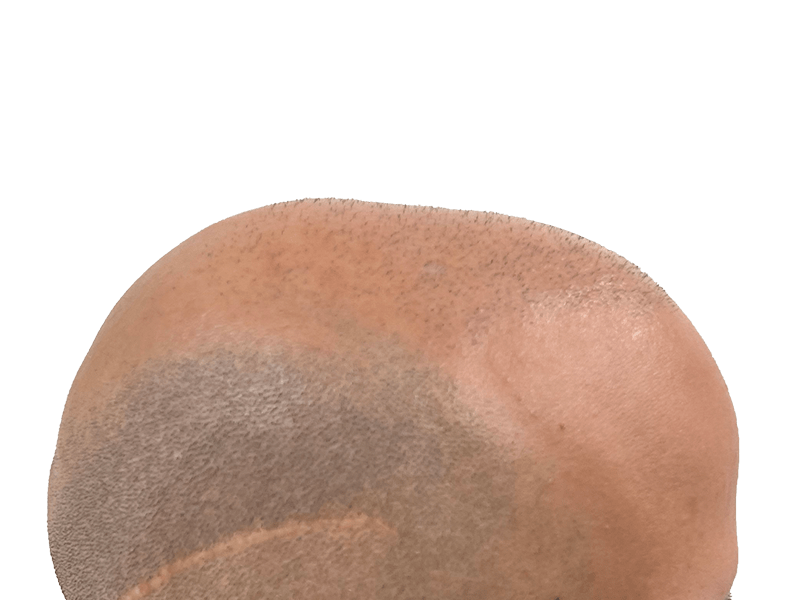 Hair transplant result: Sparse hair to fuller coverage. Before/after potential. African American/Hispanic male.