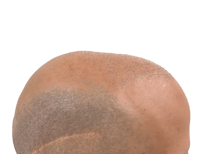 Hair transplant result: Sparse hair to fuller coverage. Before/after potential. African American/Hispanic male.