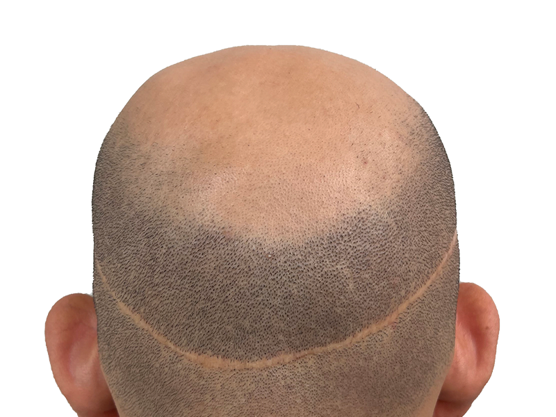 Hair transplant result: Back of head showing scar after hair restoration. Before/after hair loss solution.