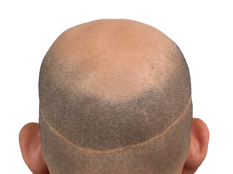 Hair transplant result: Back of head showing scar after hair restoration. Before/after hair loss solution.