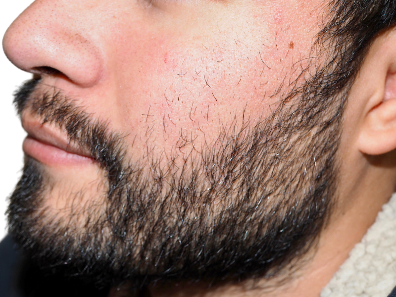 Man's beard & sparse cheek hair. Hair restoration or transplant before/after? Consult for facial hair solutions.