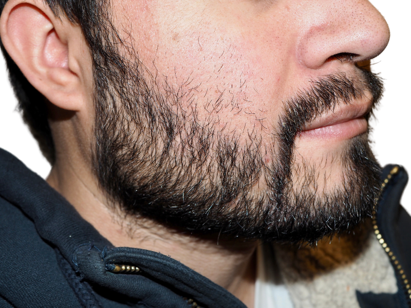 Man with dark beard. Could be a hair transplant before/after. Hair restoration results may vary. Stubble visible.
