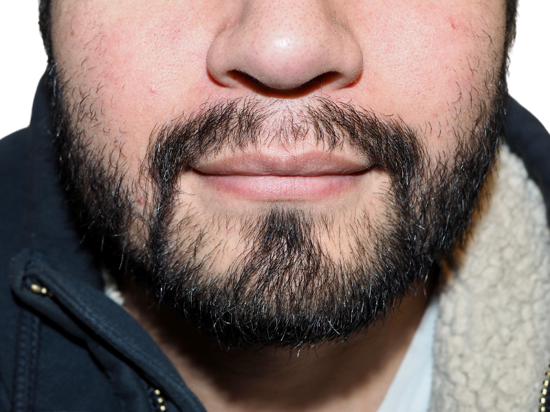 Full, textured beard (black & gray). Consider hair restoration options for beard density. Before & after results available.
