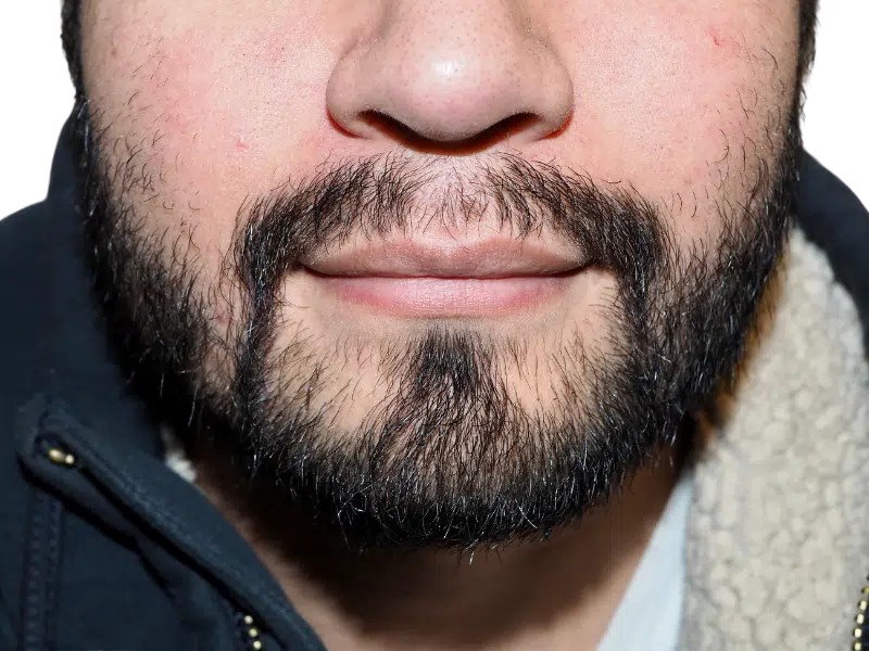 Full, textured beard (black & gray). Consider hair restoration options for beard density. Before & after results available.