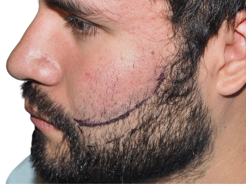 Beard hair transplant: Before/after. Man with marked beard area for restoration. Hair restoration results.