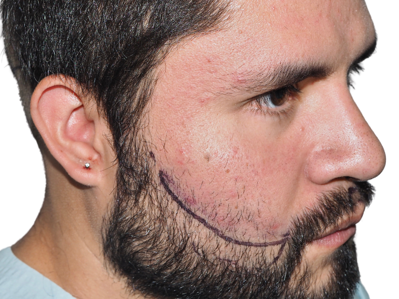 Man with dark hair & beard. Marking for potential beard/hair restoration. Possible hair transplant consultation. Before/after results unclear.