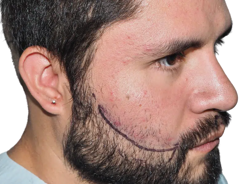 Man with dark hair & beard. Marking for potential beard/hair restoration. Possible hair transplant consultation. Before/after results unclear.