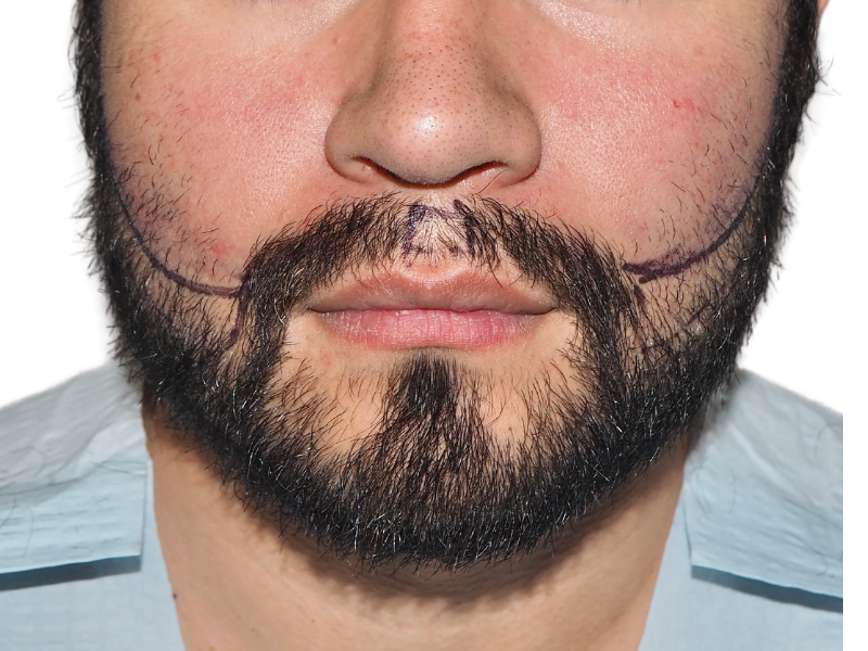 Beard hair transplant planning. Man with marked beard for hair restoration. Before procedure. Dark beard, light skin.