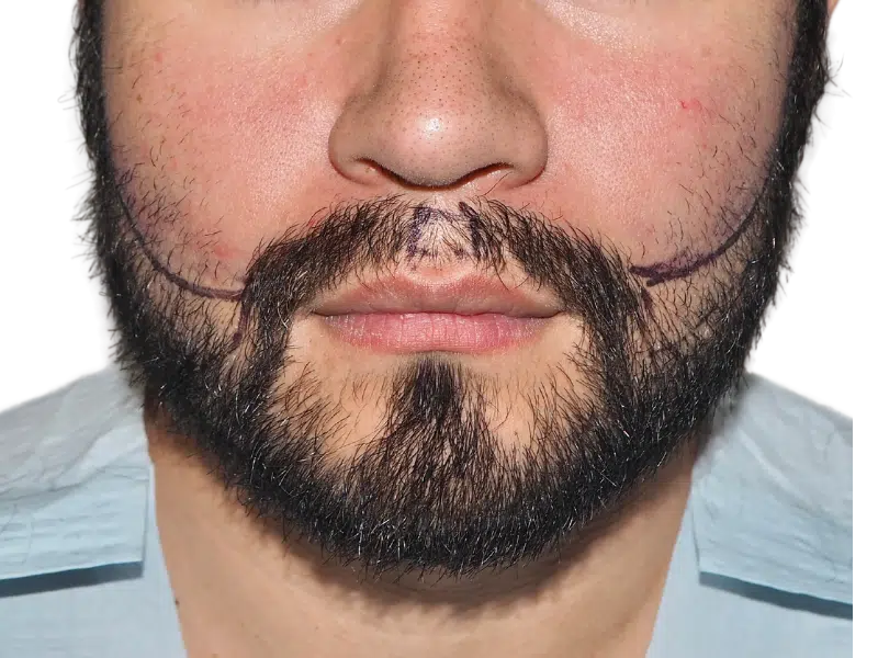 Beard hair transplant planning. Man with marked beard for hair restoration. Before procedure. Dark beard, light skin.